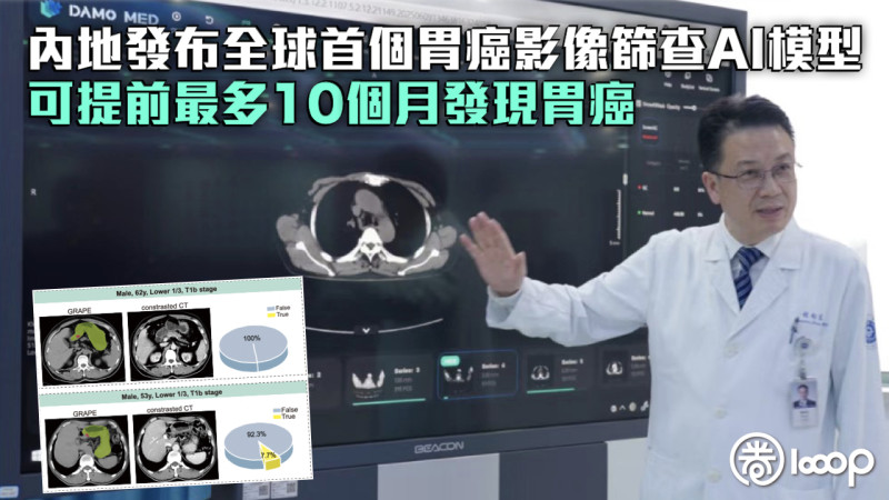 【醫療新科技】內地發布全球首個胃癌影像篩查AI模型 可提前最多10個月發現胃癌